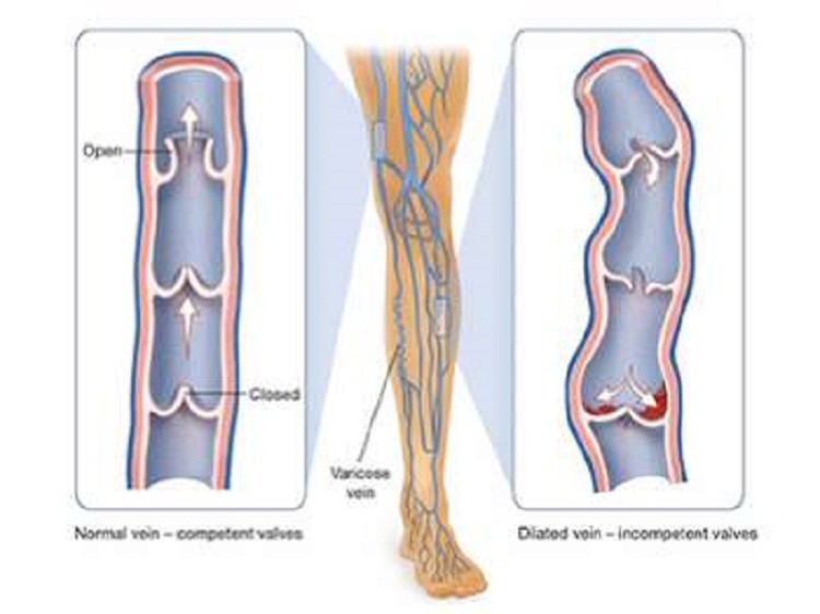 Common Vascular Conditions Treated by Vascular Surgeons in Vadodara